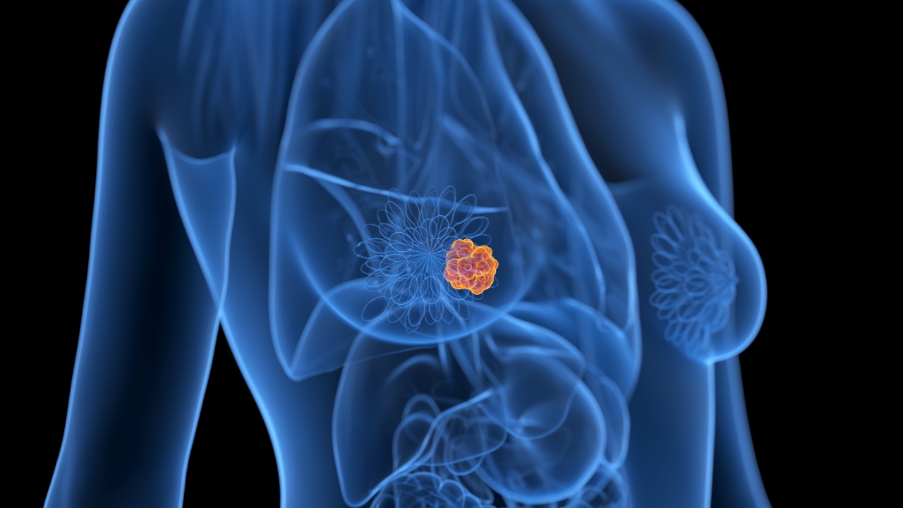 De-escalonamento do tratamento axilar em biópsia positiva de linfonodo sentinela em câncer de mama cT1–2 N0 tratado com mastectomia: estudo de registro nacional (BOOG 2013-07)
