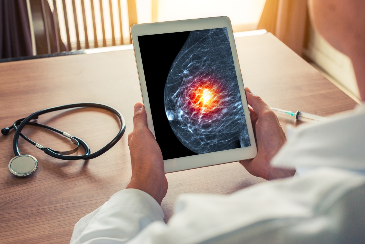 Prognóstico e resultados do tratamento de pacientes estádio IA com câncer de mama triplo negativo