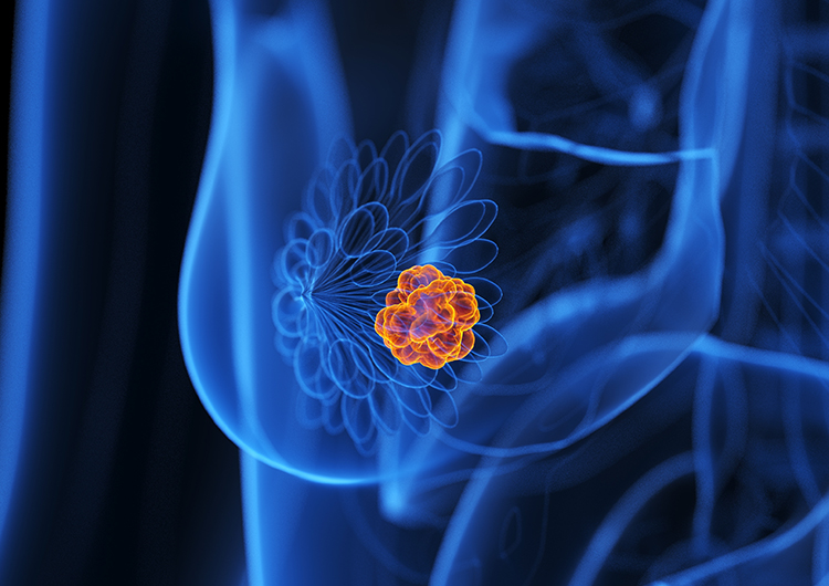 Terapia endócrina adjuvante no câncer de mama pré-menopausa: resultados de 12 anos do estudo SOFT